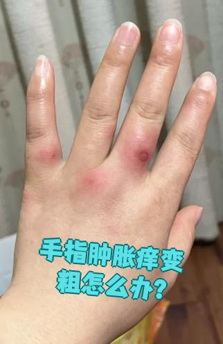 为什么会手肿 为什么会手肿