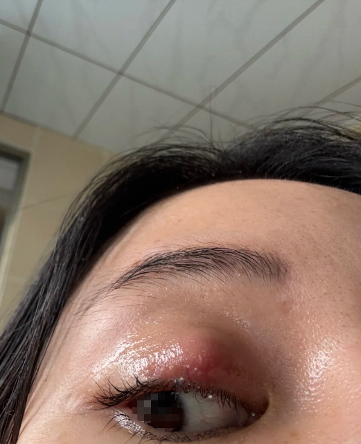 麦粒肿三个月还没好,说明炎症还在