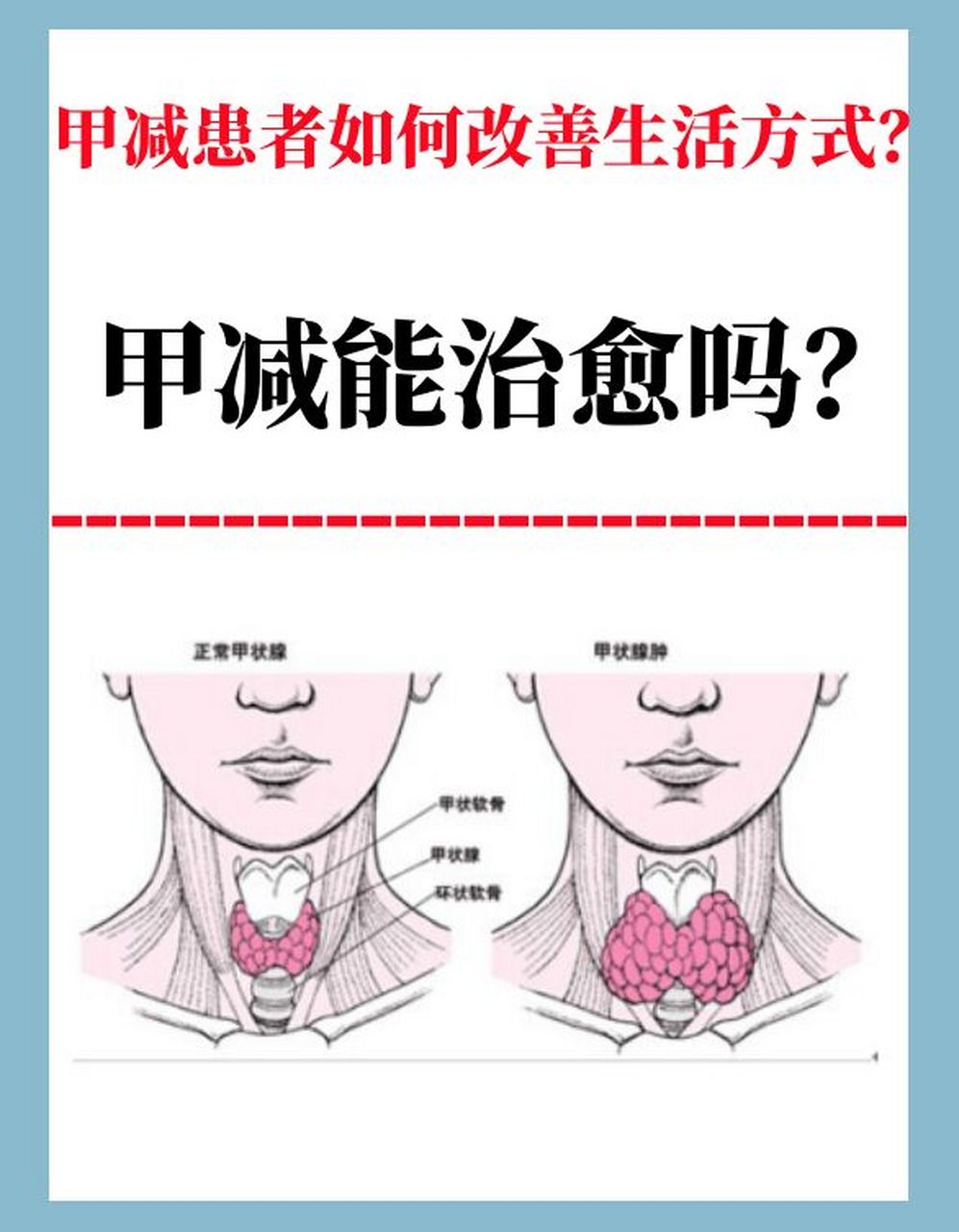 甲减患者如何改善生活方式?甲减能治愈吗?