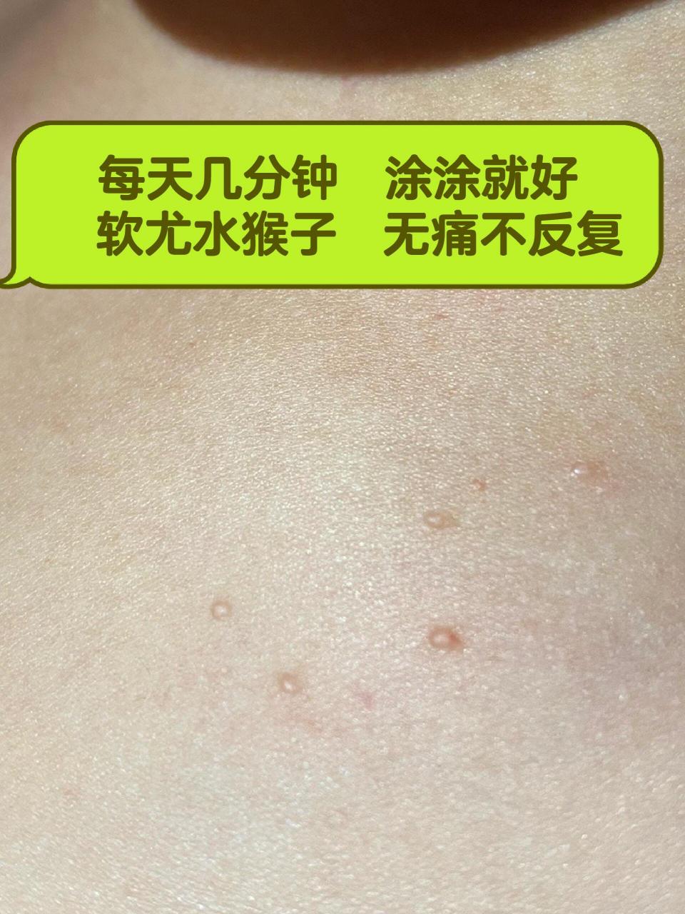 软疣俗称水猴子 全程无痛不腐蚀不留印痕 春天来了,皮肤问题也是逐渐