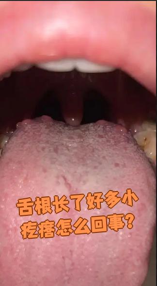 舌根长小疙瘩常见原因有三种:轮廓乳头,舌乳头炎或肿瘤