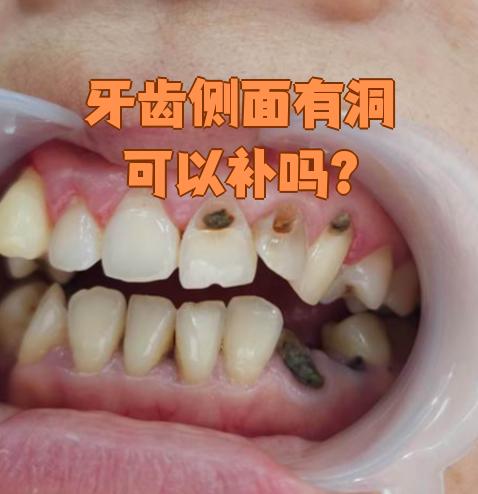 牙齿侧面有洞多半是龋齿造成的,这种情况通常可以补