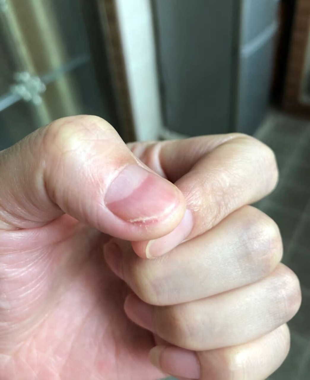 俗称的"灰指甲"其实包含两个不同的概念: 甲真菌病 甲癣甲真菌病 是