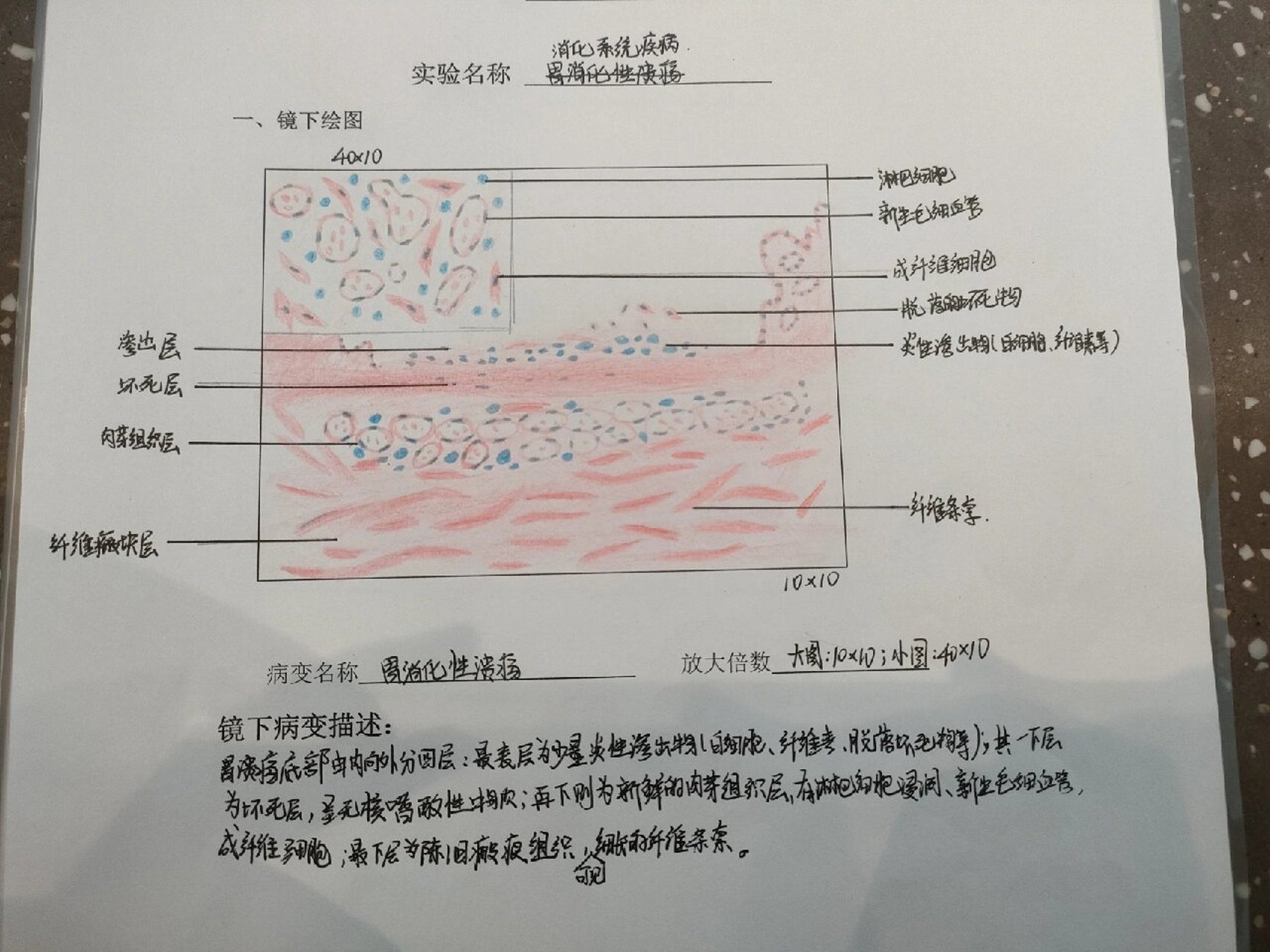 胃溃疡病理手绘图图片