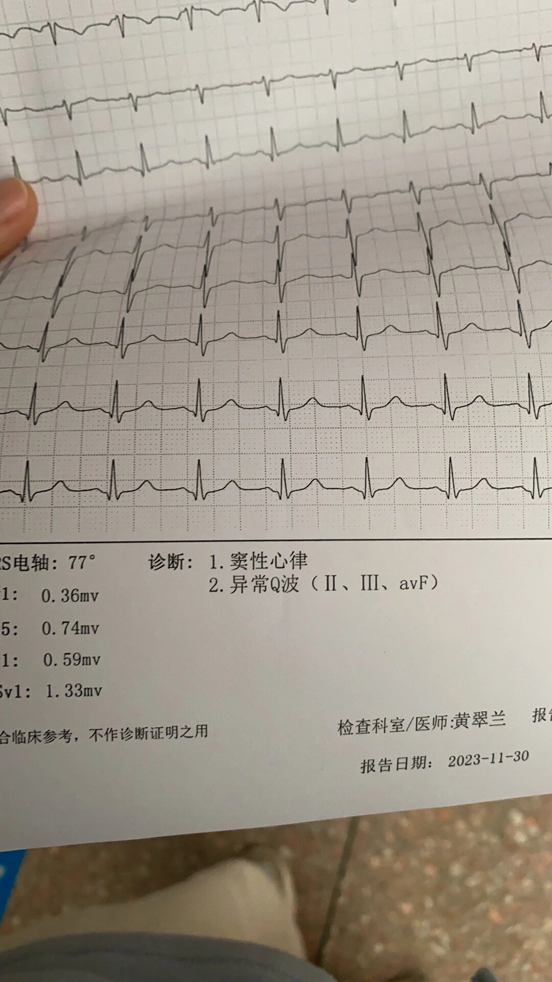 异常q波心电图表现图片