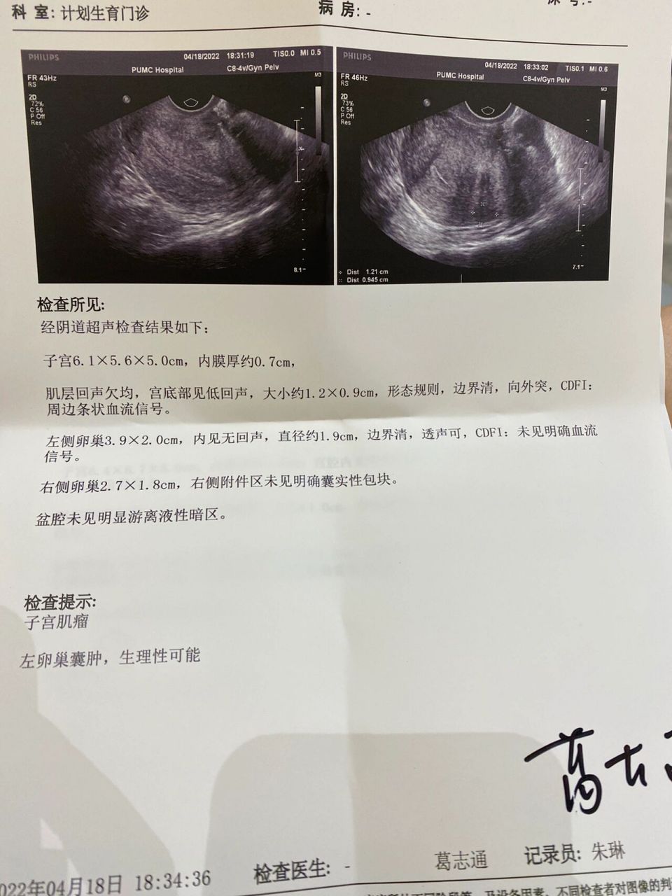 我的天 子宫内膜息肉自己掉了 去年在爱康国宾体检出来有子宫内膜息肉