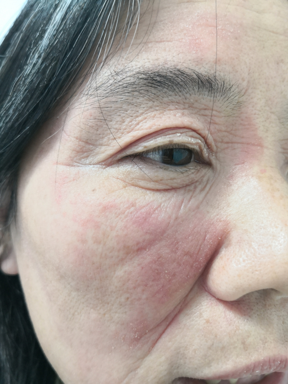 面部干燥脱屑瘙痒症状.