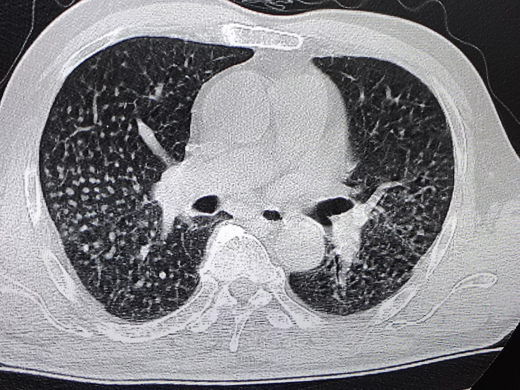 矽肺ct表现 两肺见弥漫多发粟粒结节影,可以看到两肺门,纵隔淋巴结轻