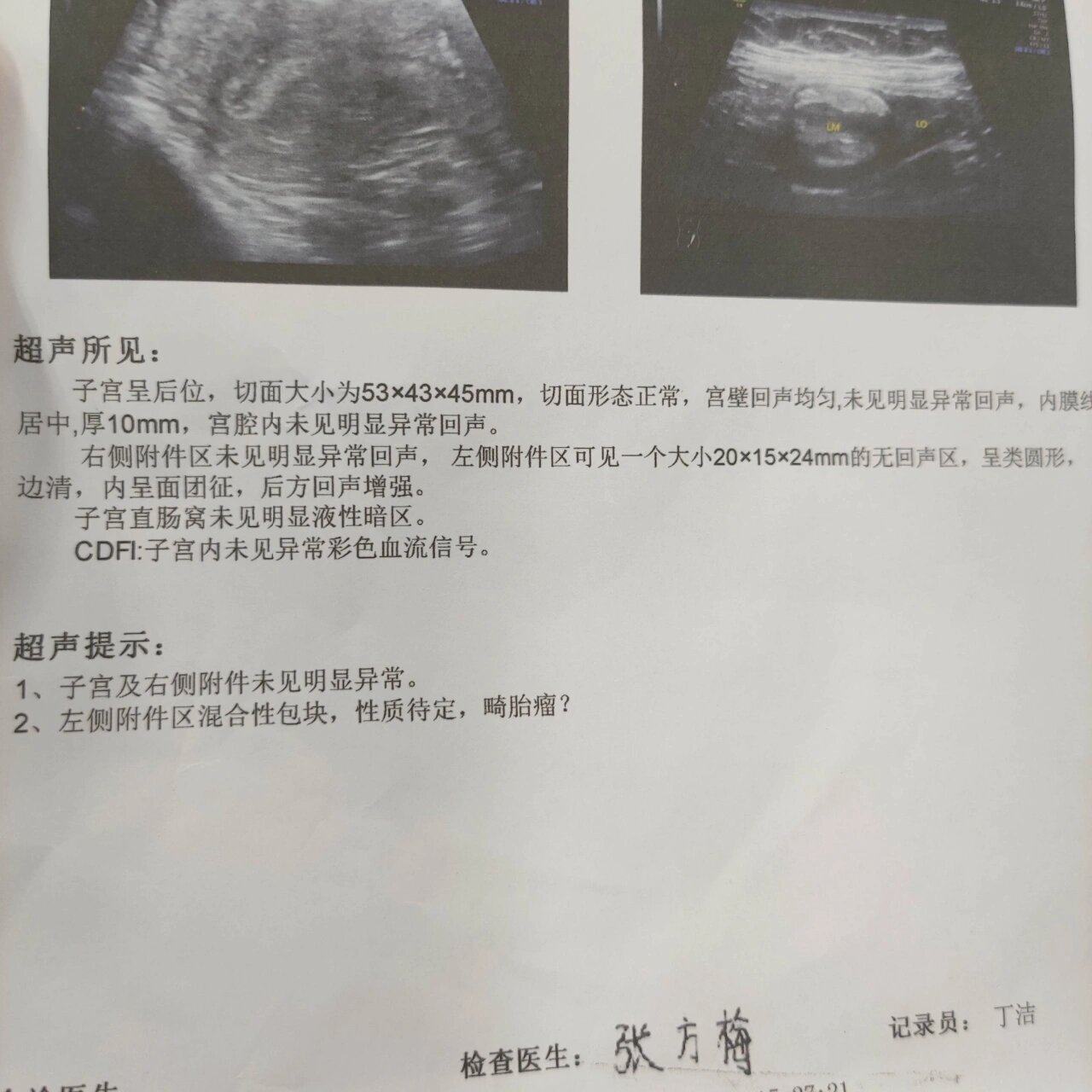 妇科查出左侧附件混合性包块,感觉好慌