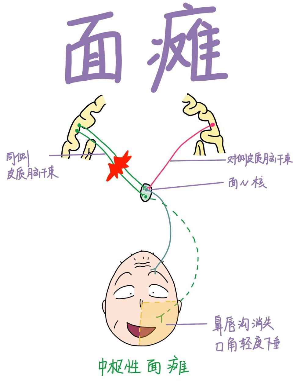 医学生笔记|中枢性面瘫和周围性面瘫 8215这次画的是面瘫 82