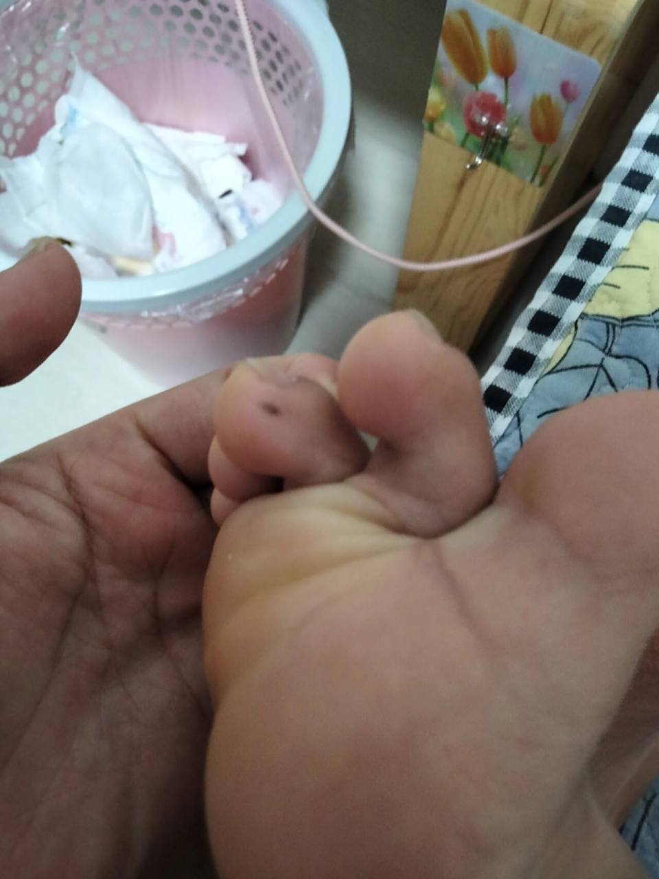 脚趾痣 脚趾长痣不好吗?