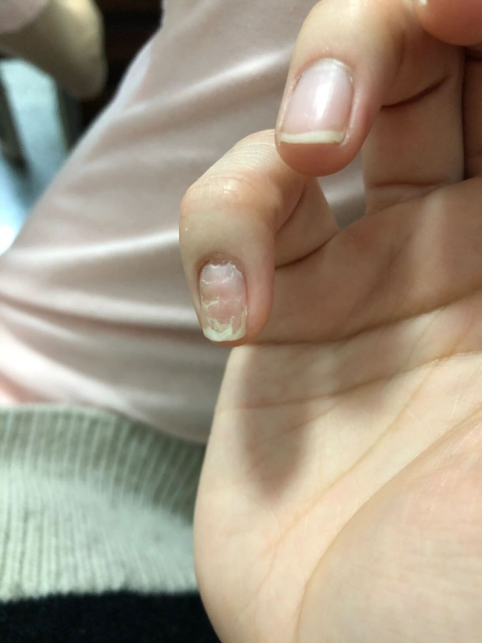 指甲凹凸不平 我的尾指有它自己的想法.