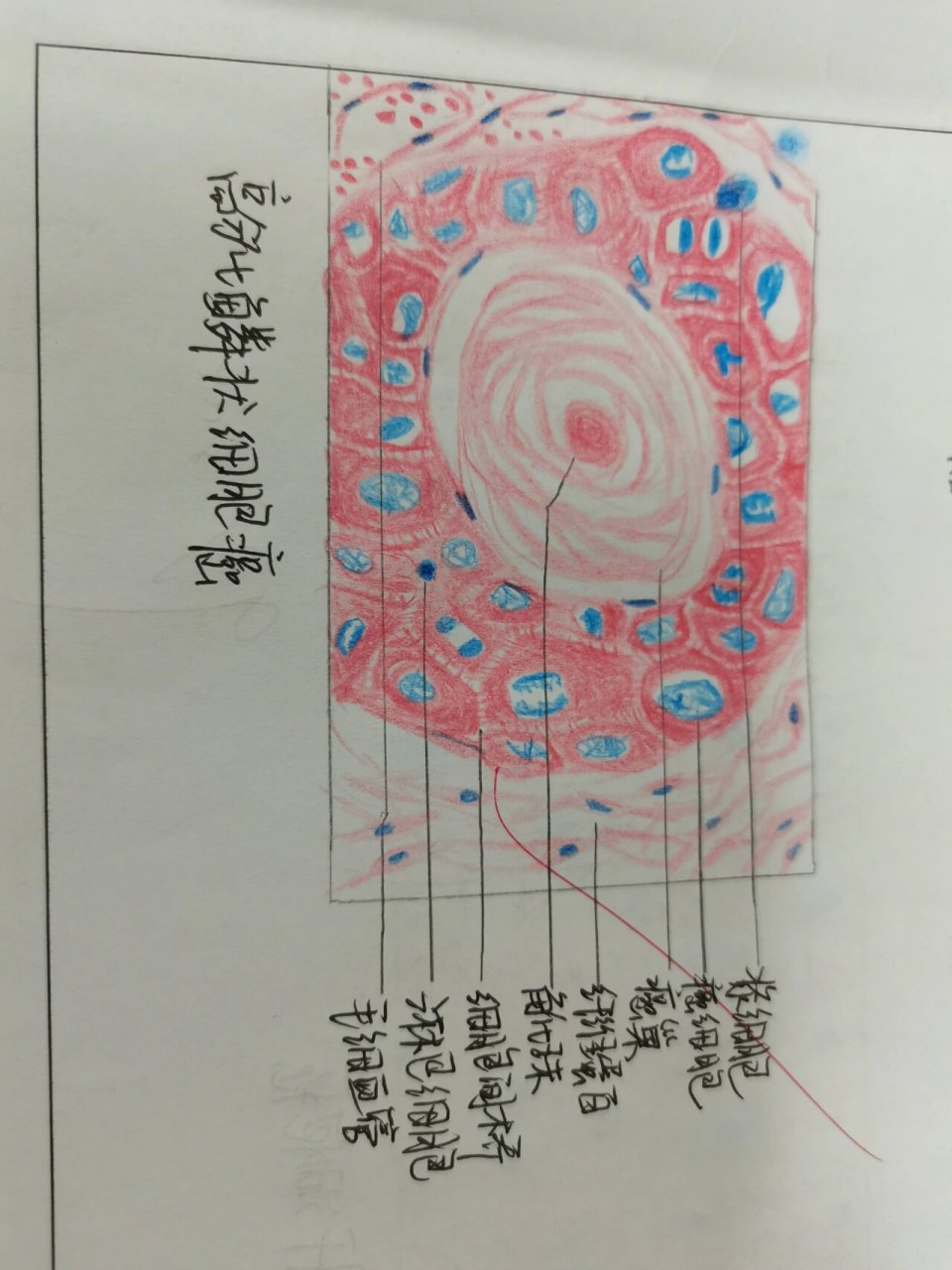 病理肿瘤红蓝铅笔图 皮肤乳头状瘤 高分化鳞状细胞癌 淋巴结转移癌