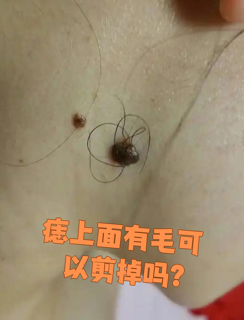 痣上长毛是可以剪掉的,这不会伤害身体
