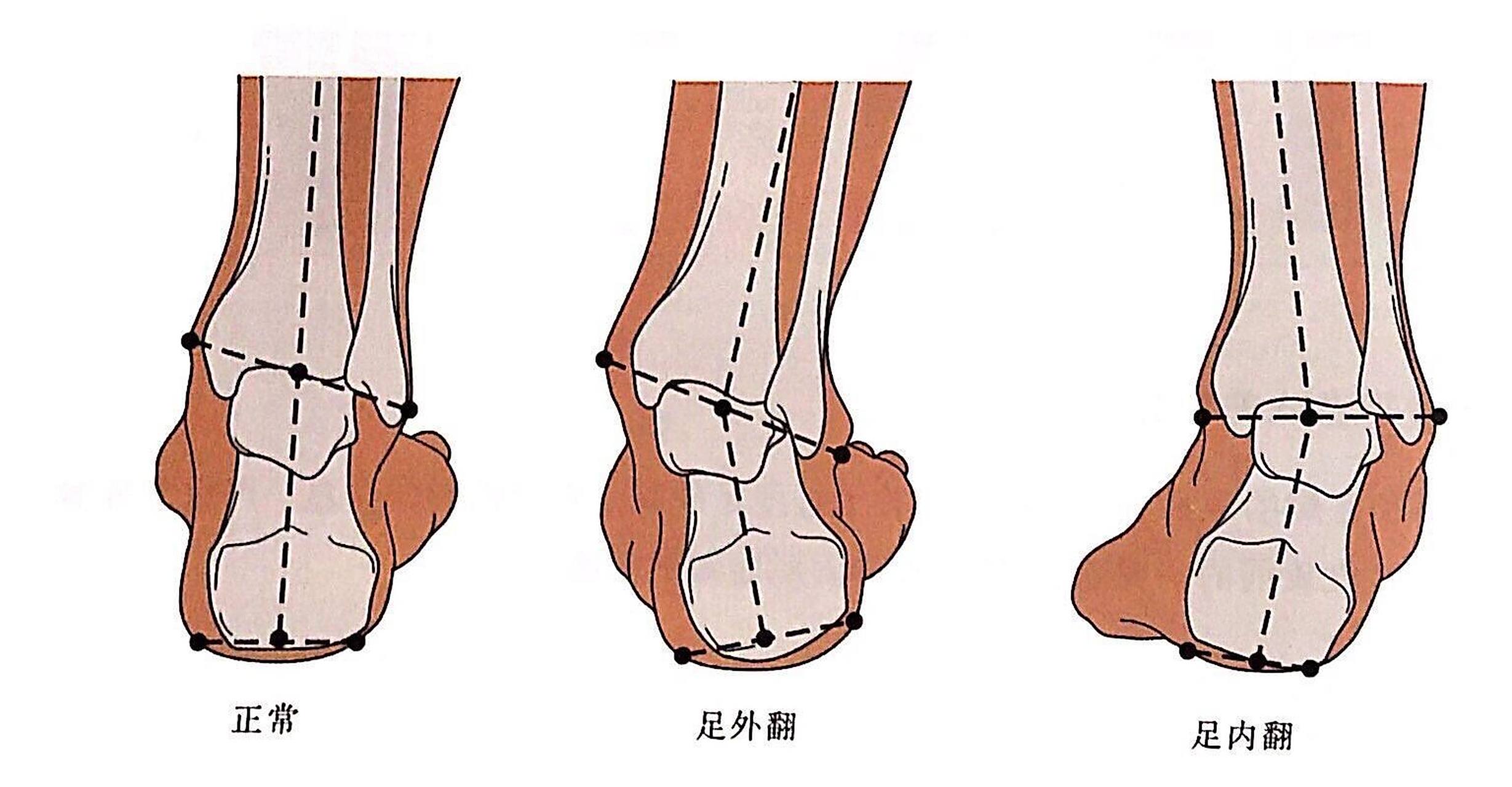 如何判断足内翻还是足外翻 所谓的内翻足是脚心朝里的脚,内翻足和外翻