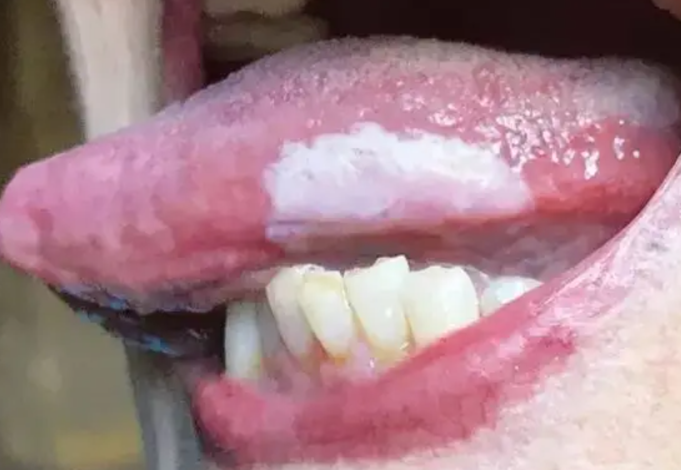 舌根一侧出现乳白色白斑,常见原因有口腔白斑,口腔溃疡或艾滋病妇染