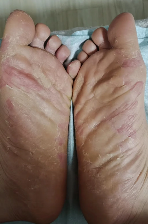 脚气是由真菌感染引起的皮肤病