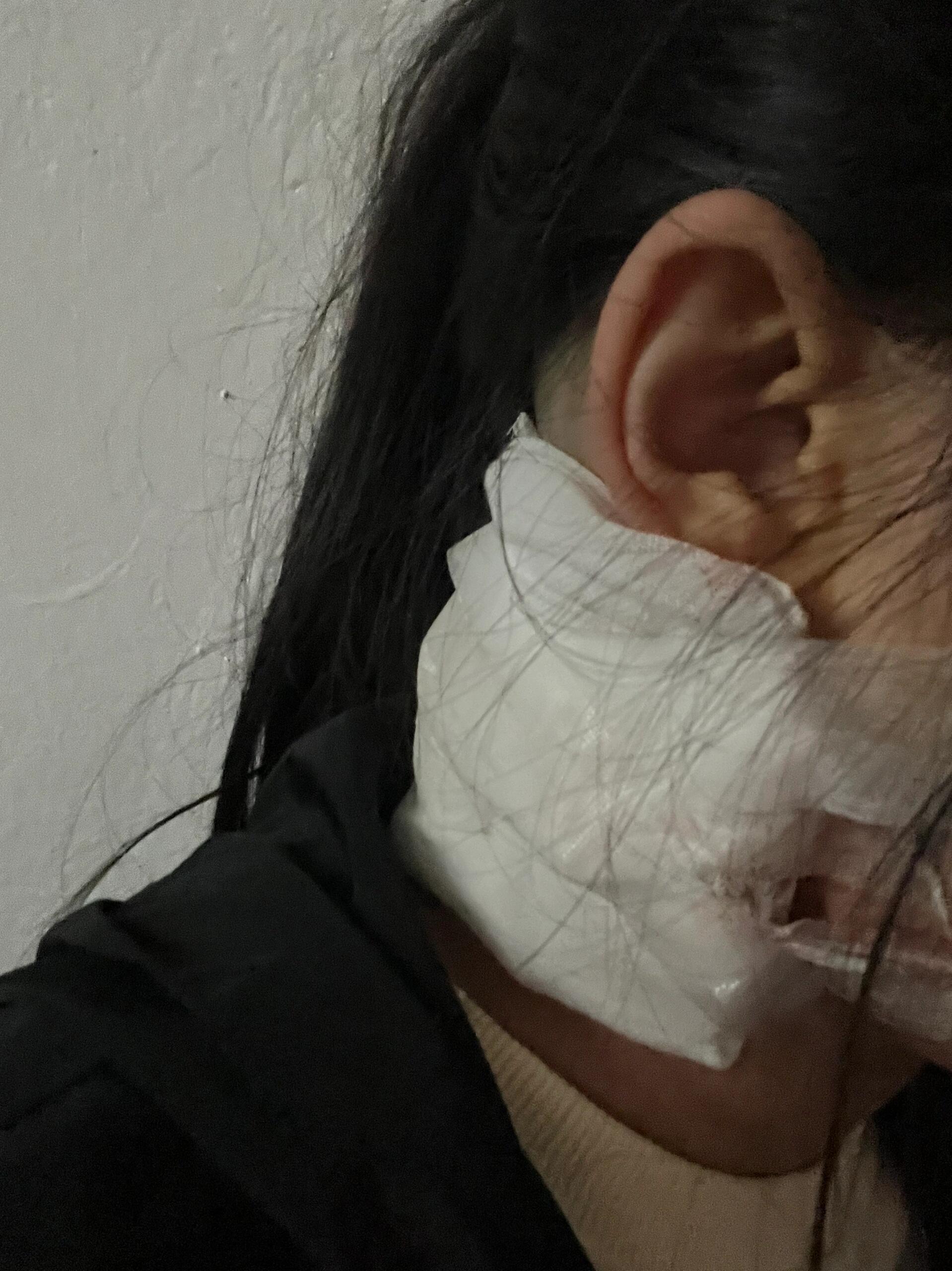 长在脖子后面的脂肪瘤今天去做了.