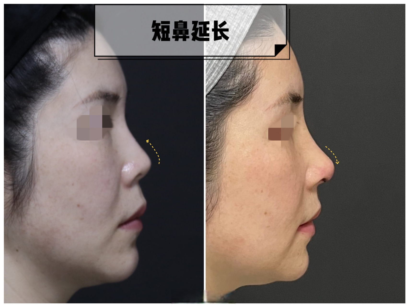 短小鼻延长,术后一周,延长鼻子的同时,要做鼻翼退缩矫正,不然正面会露