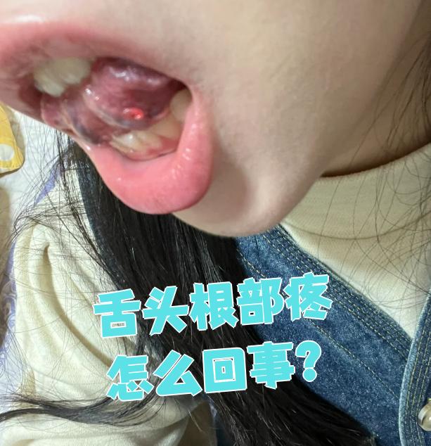 舌头根部疼痛常见原因包括溃疡,炎症或肿瘤等问题