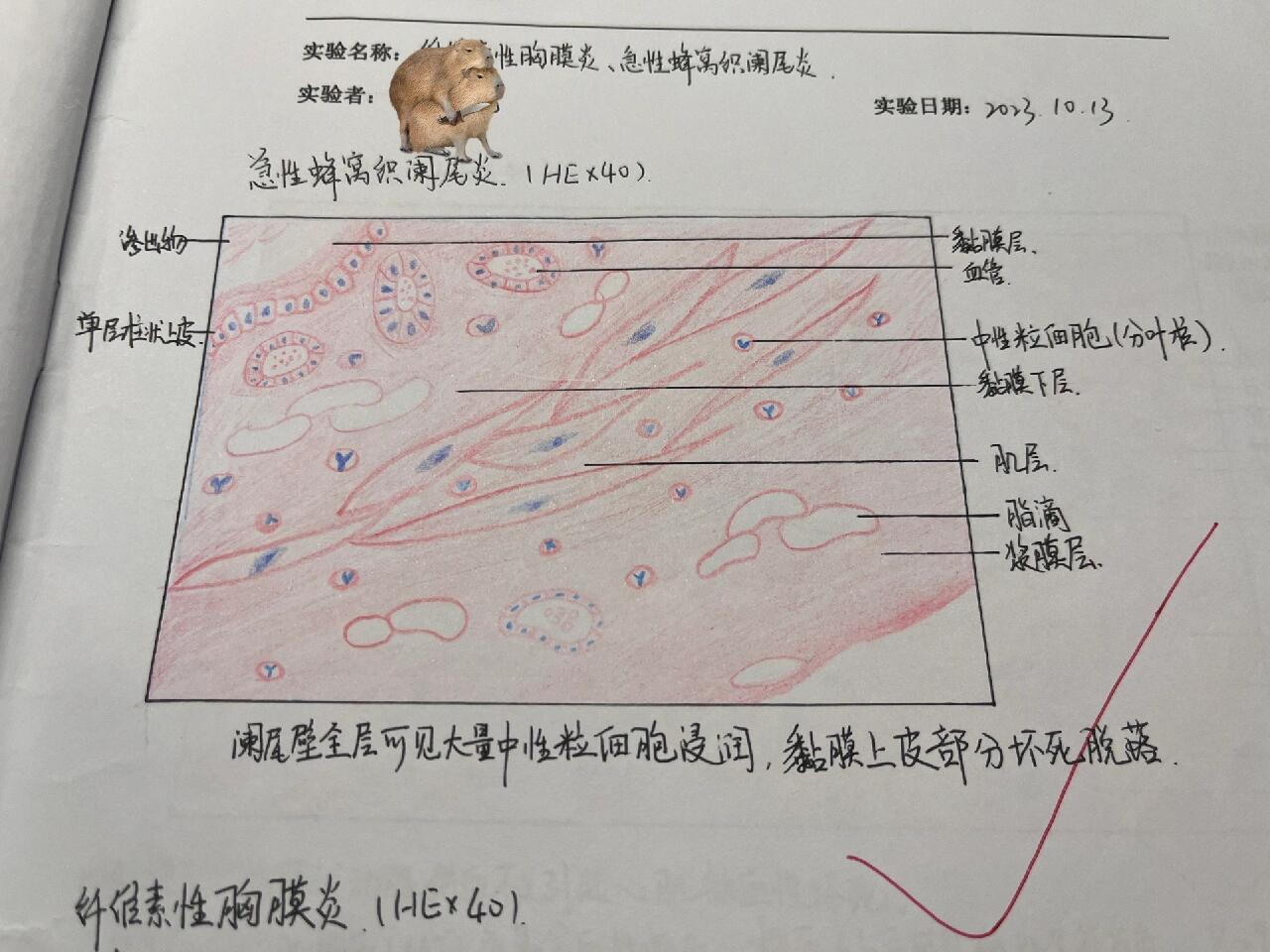 纤维素性胸膜炎,急性蜂窝织炎红蓝铅笔图 纤维素性胸膜炎 急性蜂窝织