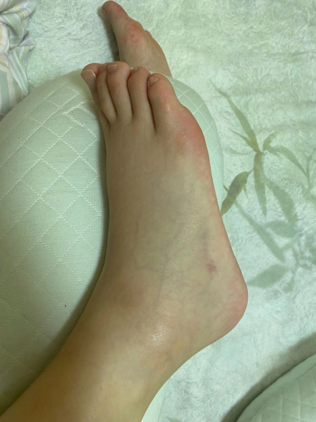看看你们孕晚期脚肿的照片
