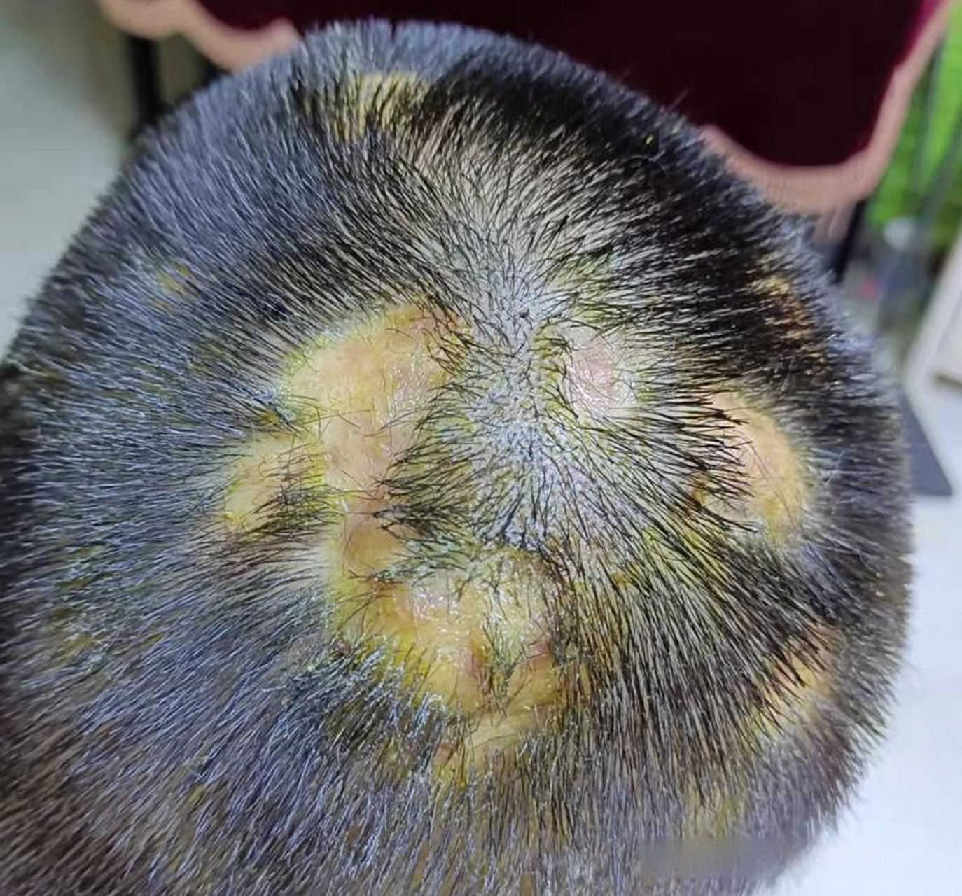 这位患者是一位大学生,刚开始时我发现他的毛囊炎非常严重,头上劈包