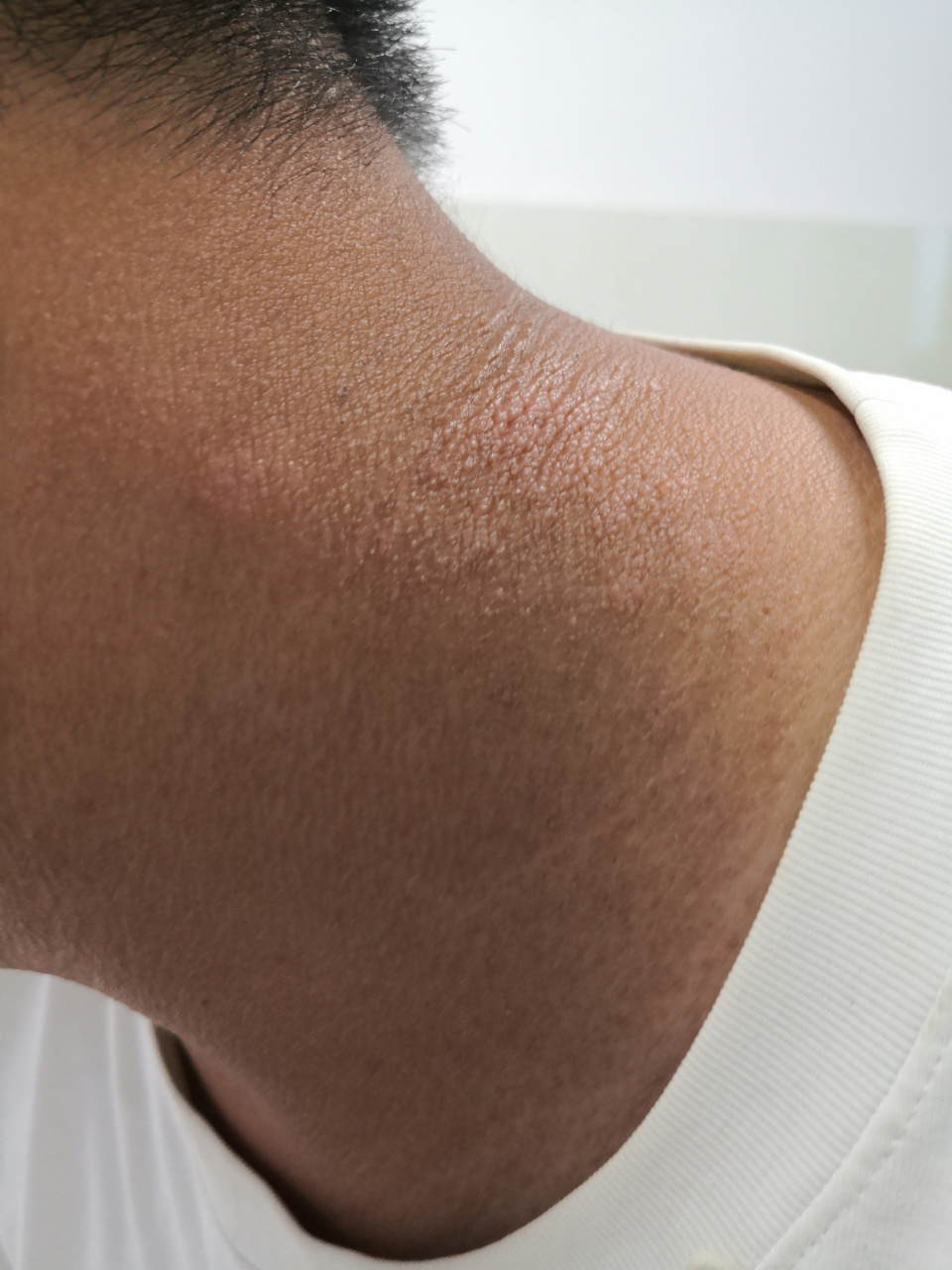 考虑日光性皮炎症状和神经性皮炎症状#解决皮肤问题专注皮肤美容