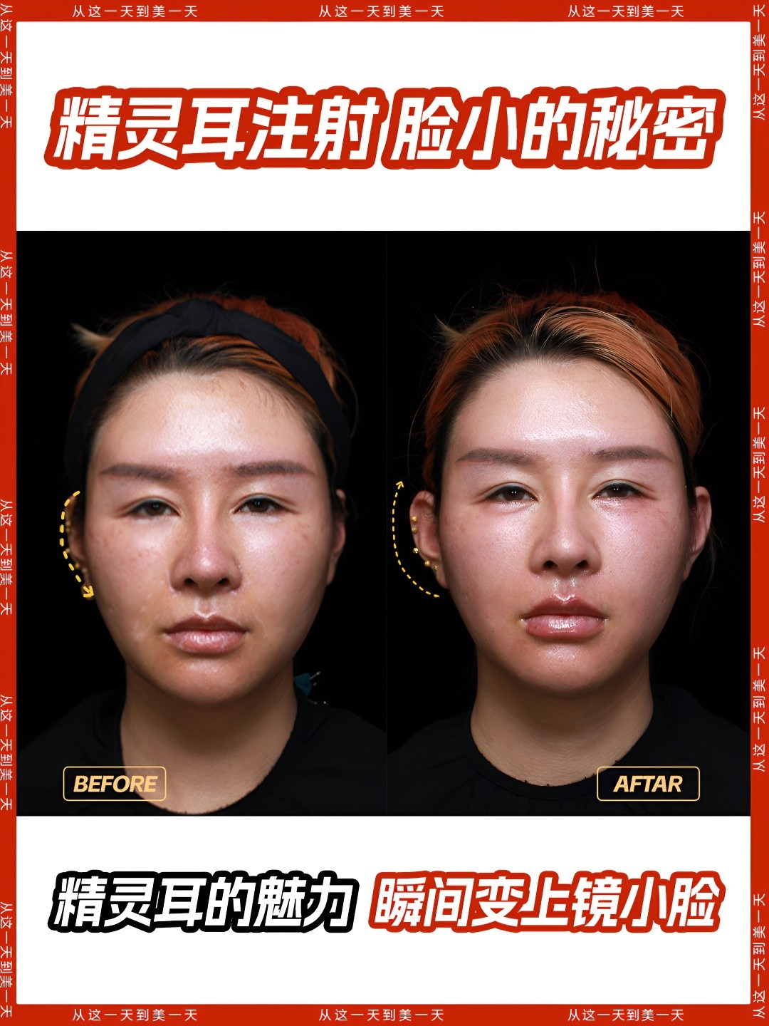 精灵耳注射变立体精致 谁不想拥有像小精灵一样灵动可爱的耳朵呢?