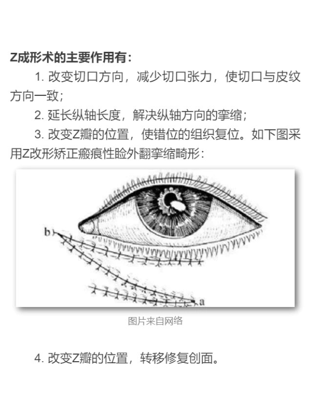 z成形术图片