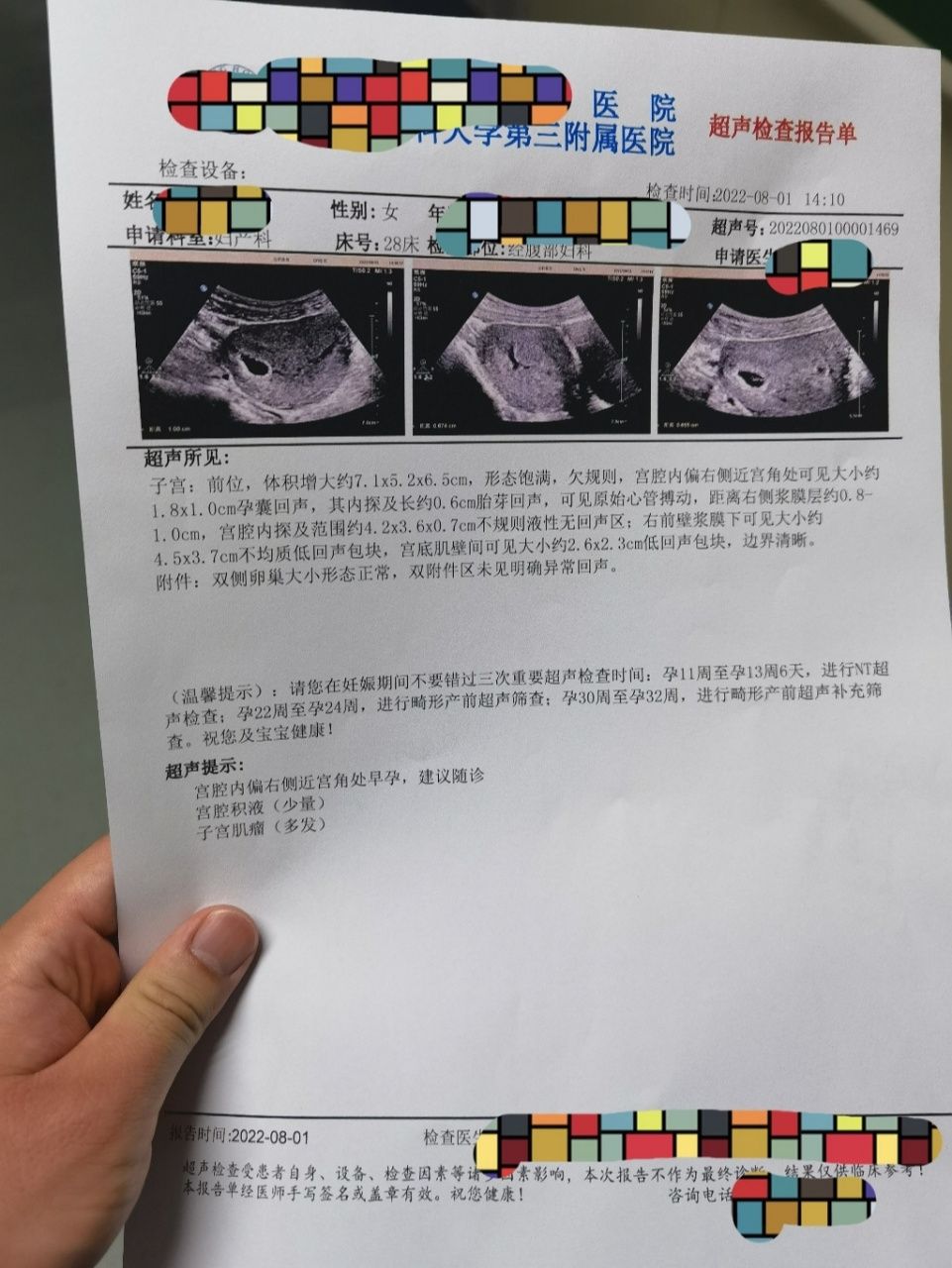 【疑似宫角妊娠】 自测两道杠,7月22号因褐色分泌物增多去医院检查