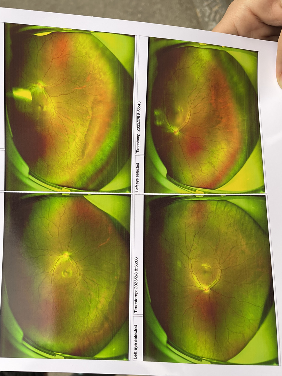 眼底照相有谁会看结果吗?