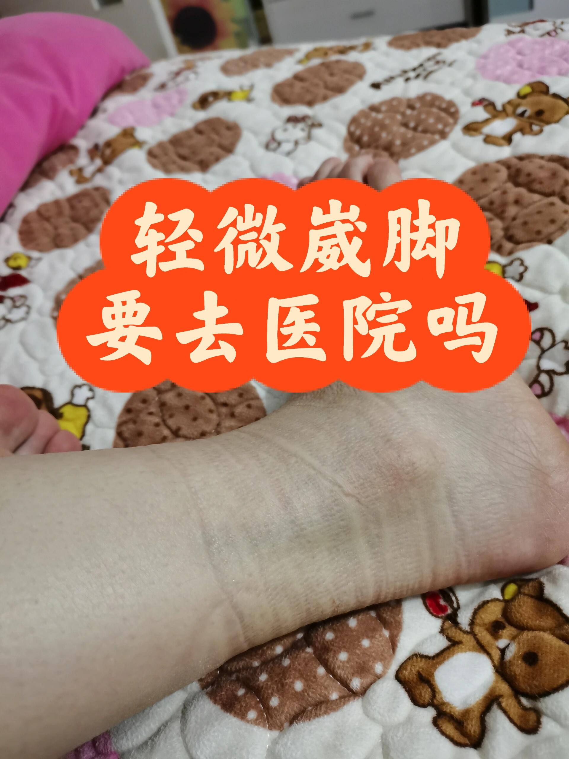 轻微崴脚多长时间能消肿啊要去医院吗