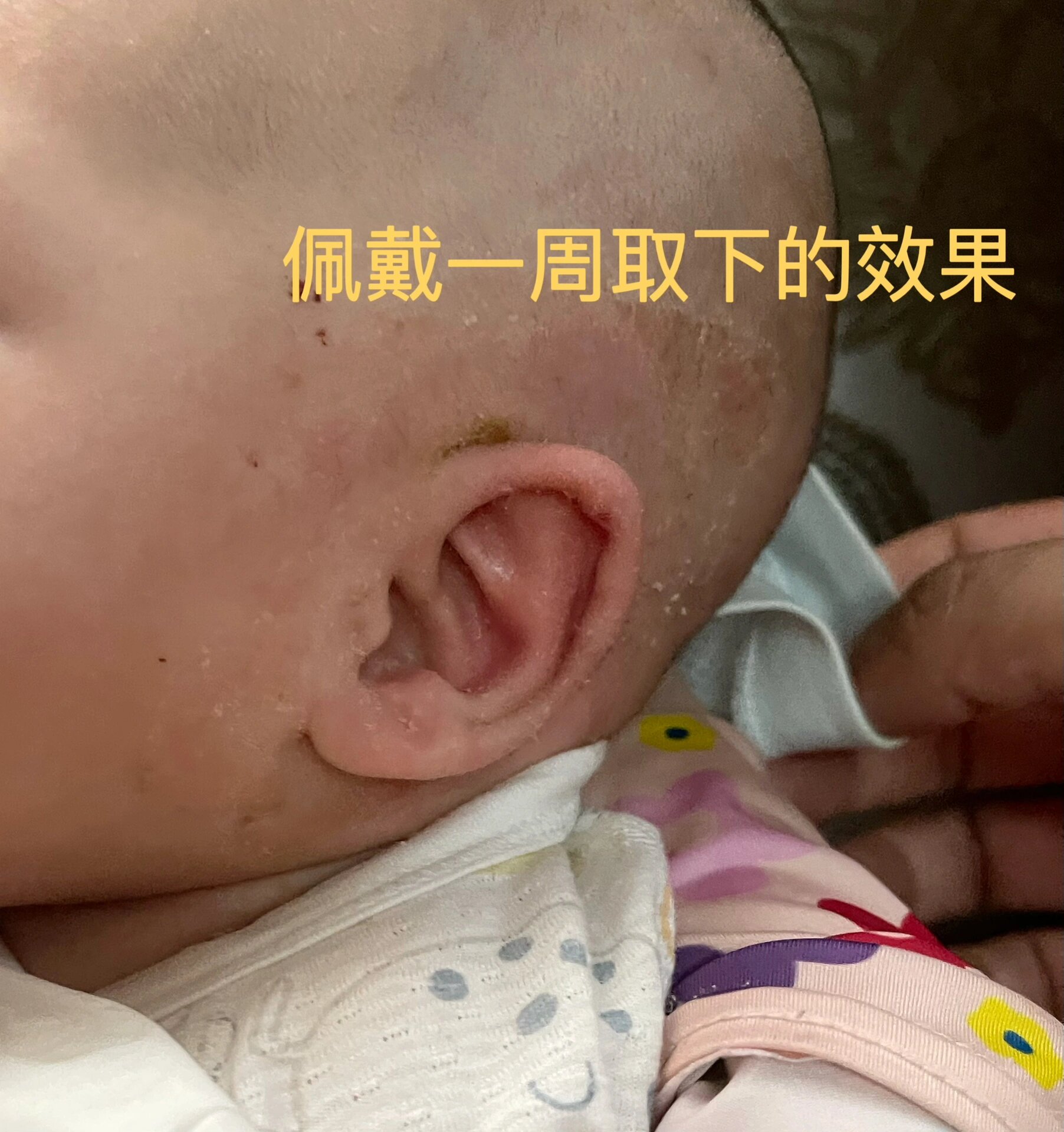宝宝刚出生的时候 医生说耳朵属于杯状耳 建议我们矫正 当时好多人都