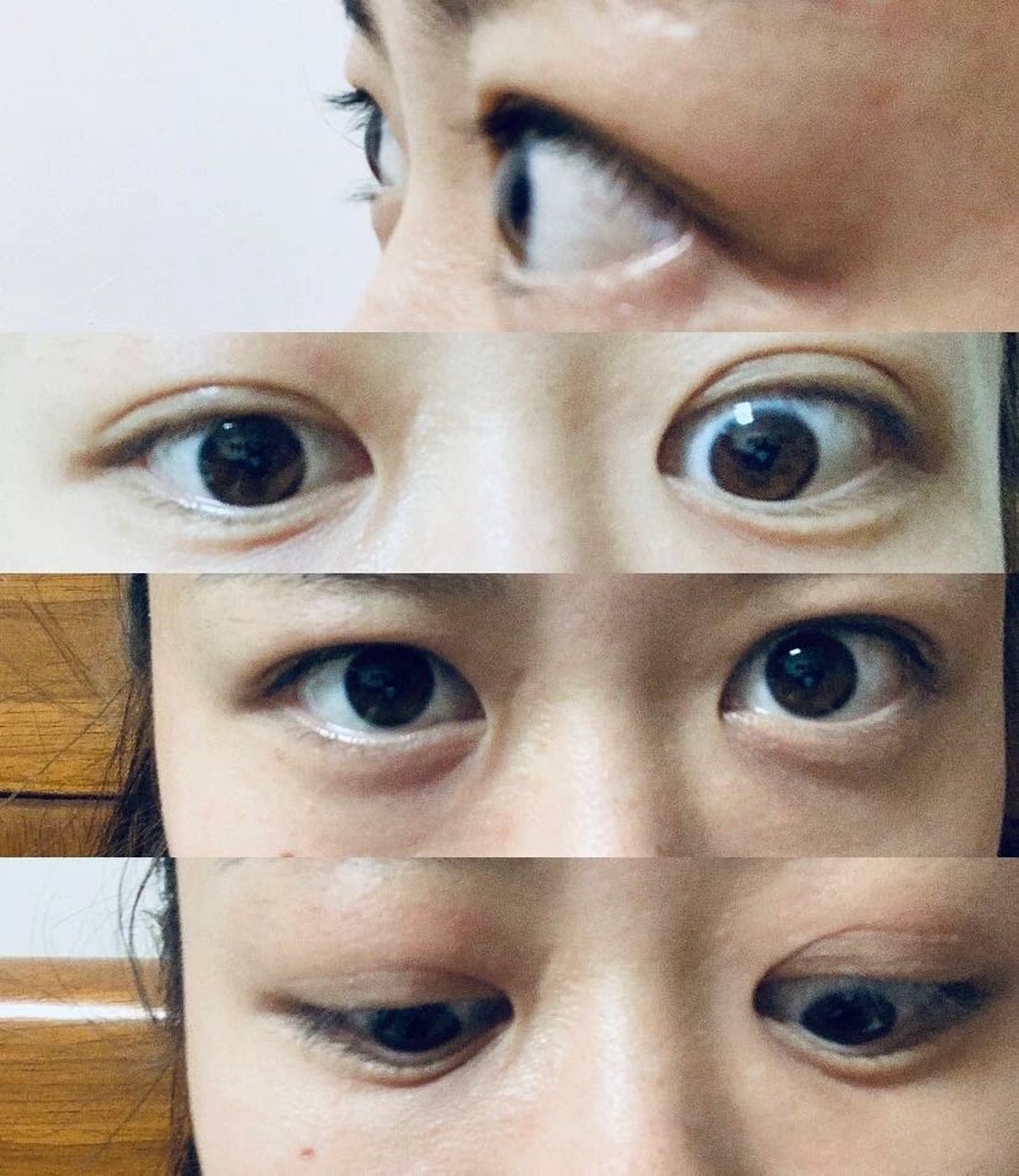 甲亢突眼 恢复全过程 很简单:1.