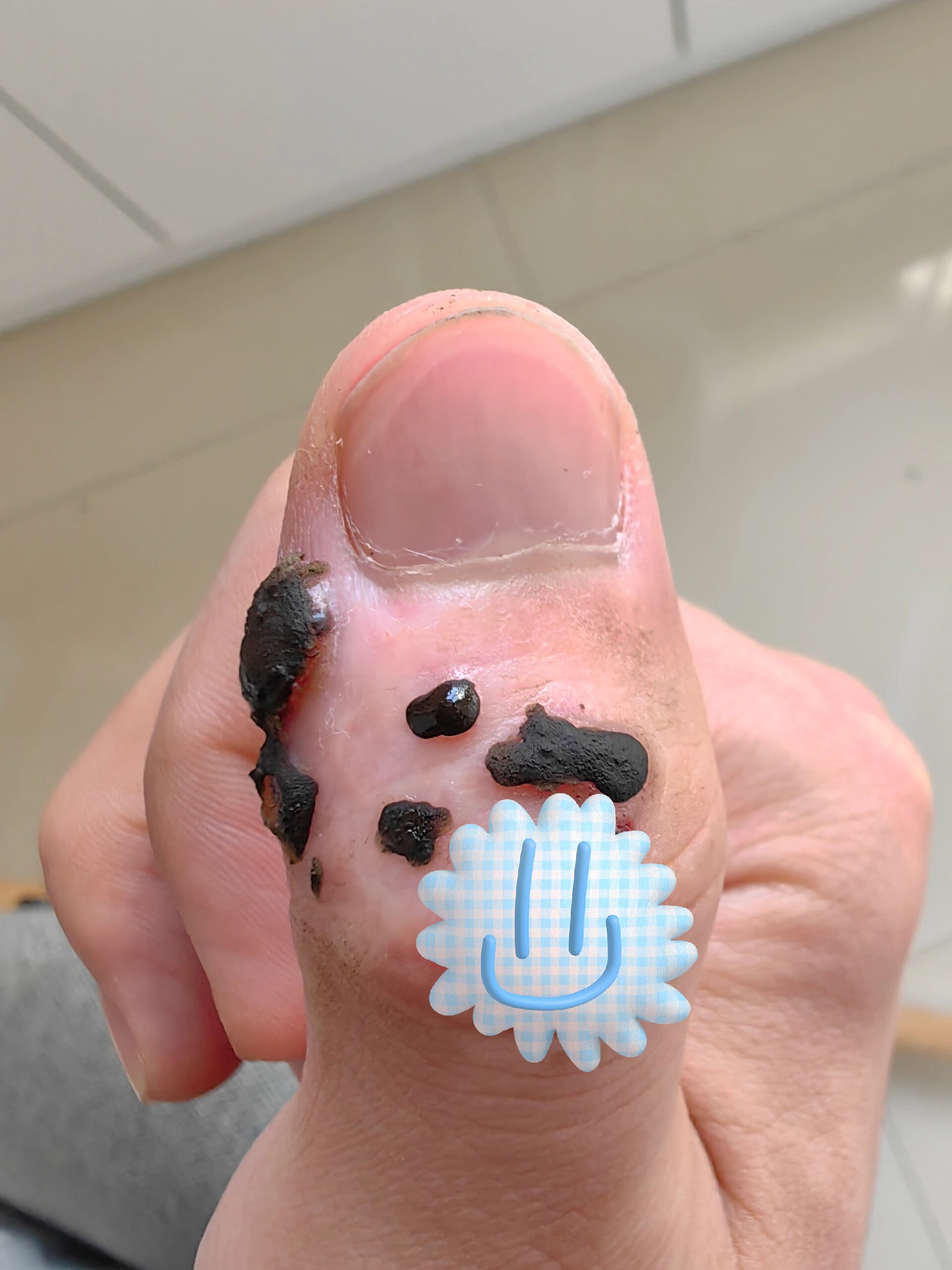 寻常疣治愈过程 本人大拇指头长了一个寻常疣,去家附近的医院看,大夫