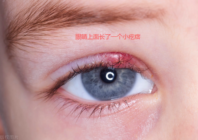 眼睛上面长了一个小疙瘩 眼皮上出现的小疙瘩常见原因:麦粒肿,霰粒肿