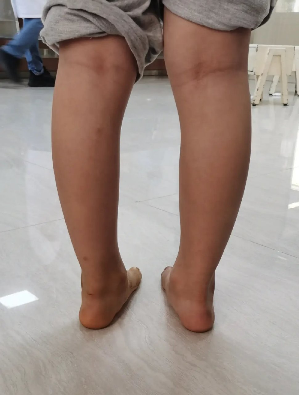 "医生,我家孩子5岁o型腿,能长直吗?