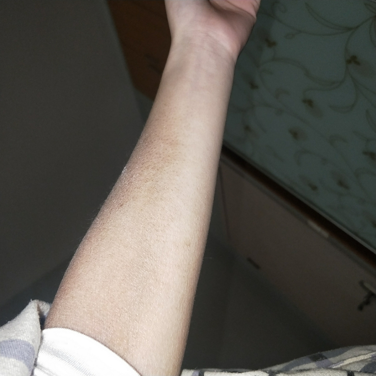 本人19年七月份确诊皮肌炎 先开始胳膊上是红色的皮疹,后来慢慢发展成