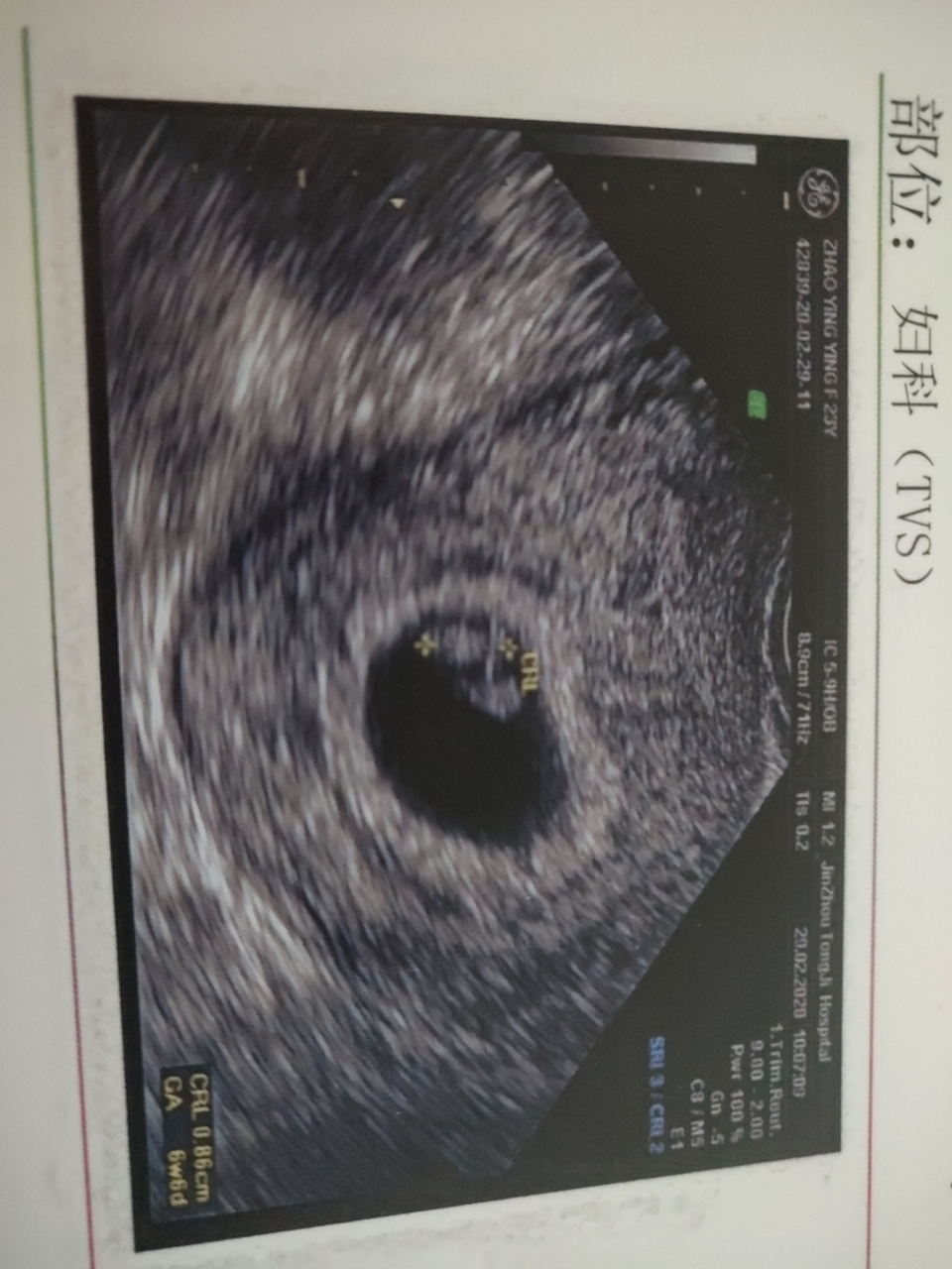 看图能看出男女吗?6周的阴超