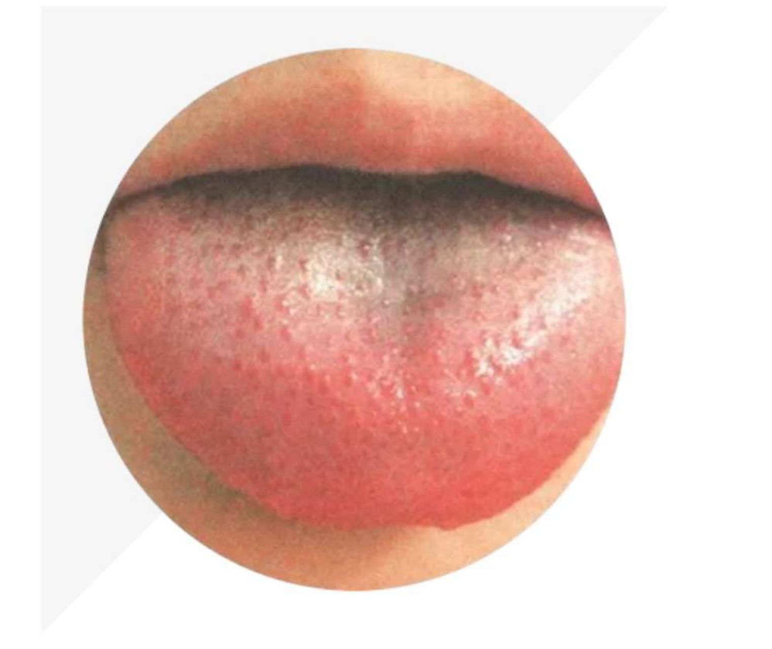 红舌——有热邪 舌尖红有芒刺表示心火上炎;舌色较红,舌苔黄且干燥