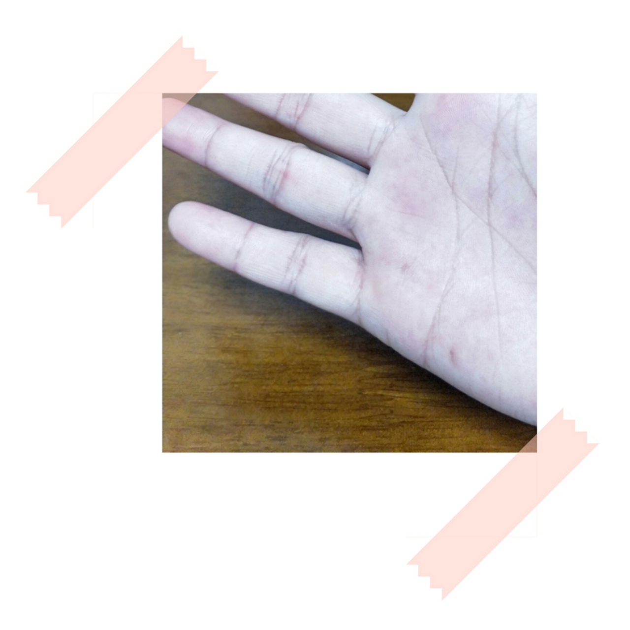 我有两颗掌心痣,(月牙形)是出生就有,(圆形)是后天的,圆形痣在今年