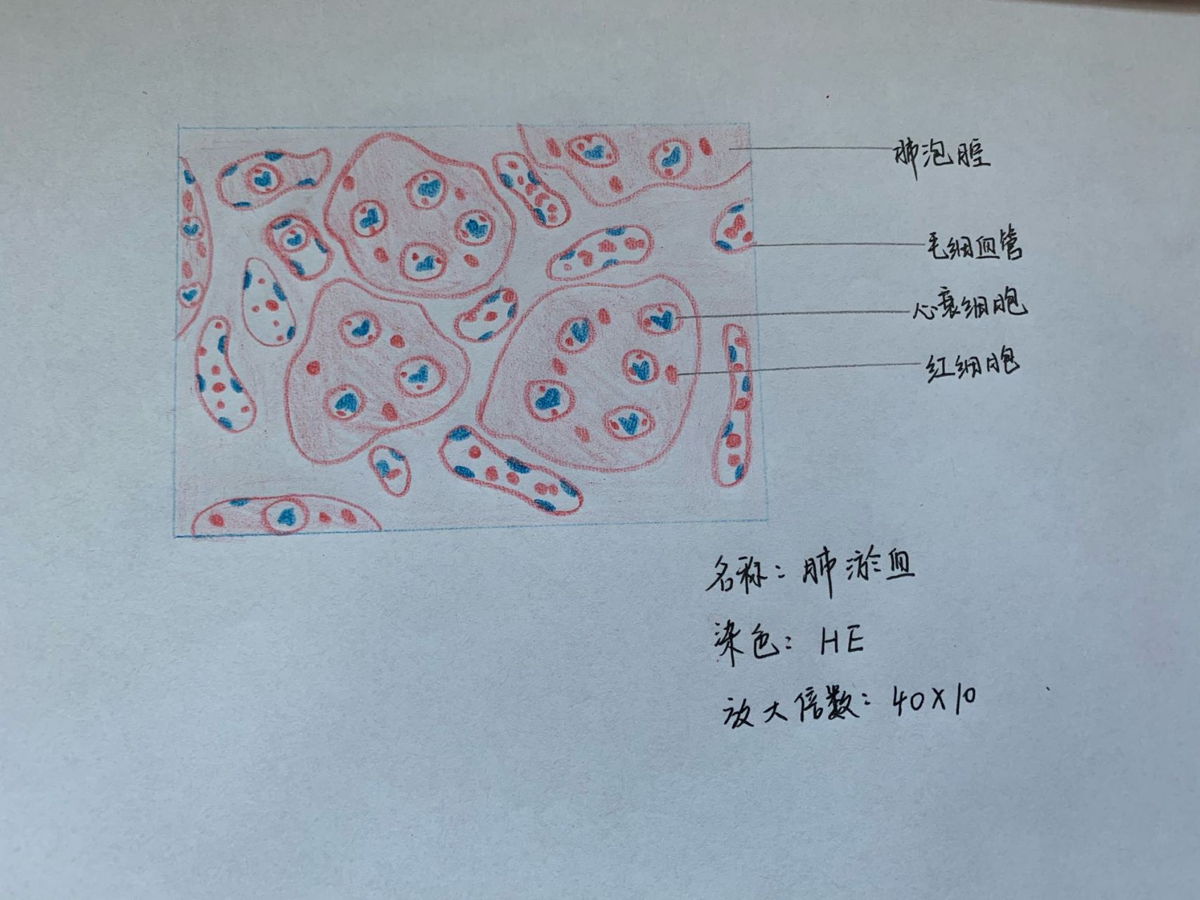 肺淤血绘图图片