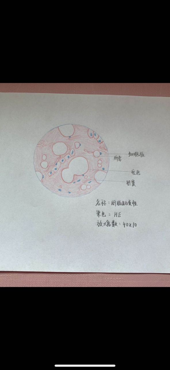 肝脂肪变性红蓝铅笔绘图