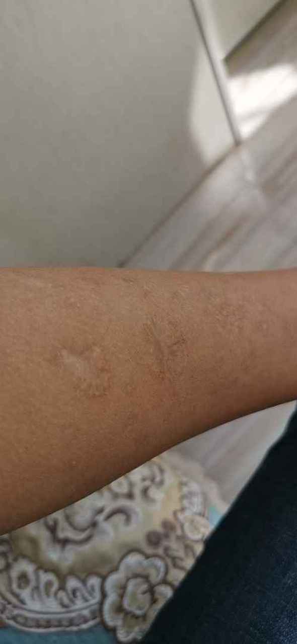 二十多年的烟疤,手术切除半个月的效果,后期再上图