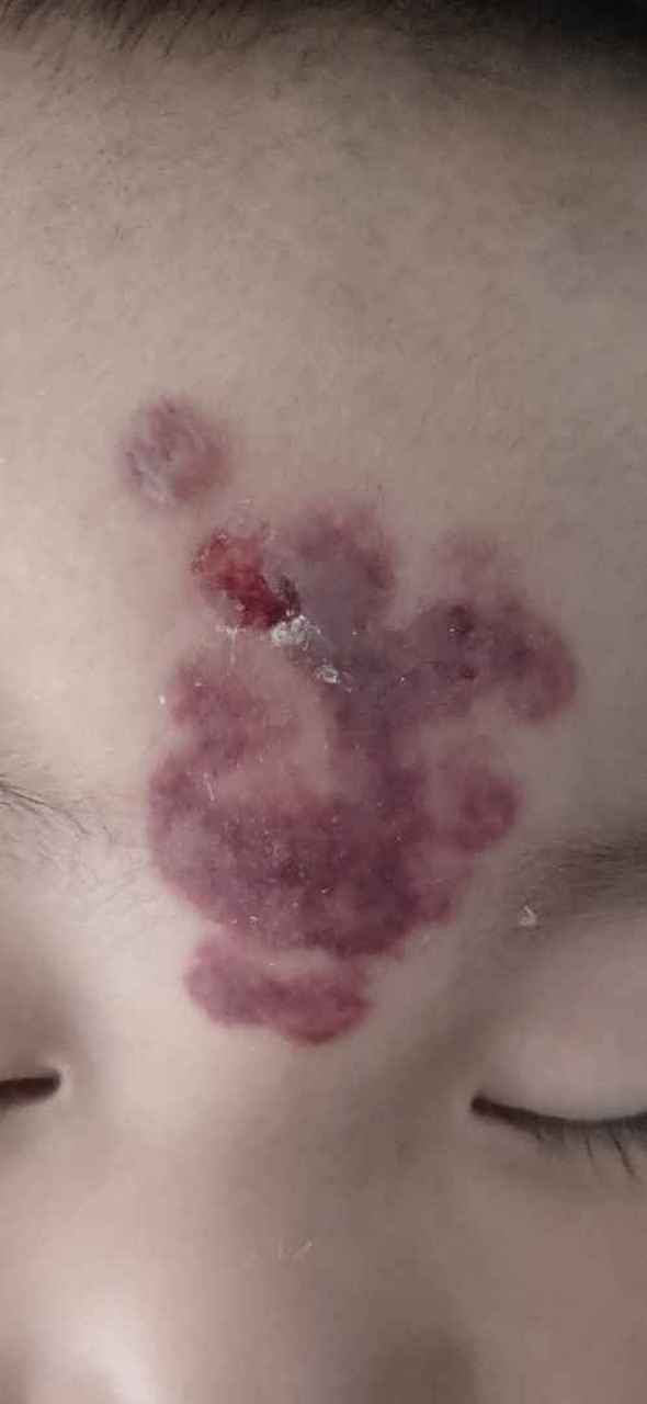 记录一下,鲑鱼斑激光第二天,宝宝给蹭破一块皮,担心会不会留疤#(泪)