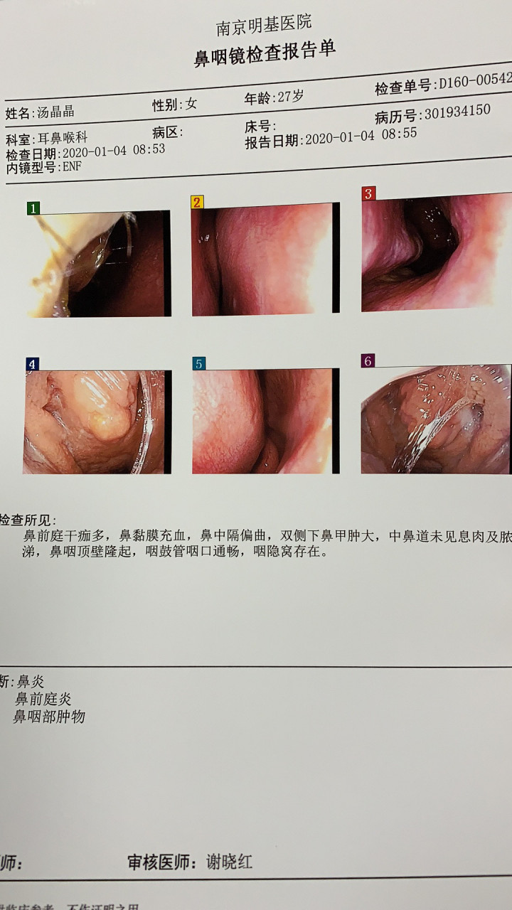 正常鼻内镜鼻咽部图片图片