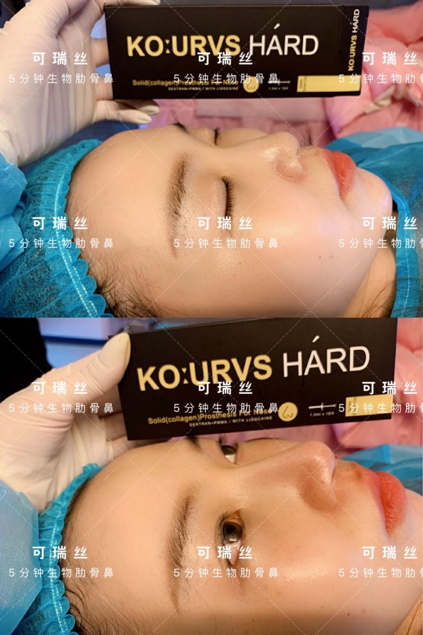 葡聚糖生物肋骨鼻:一直不敢做假体,这俩年这个很火,观察很久了终于打