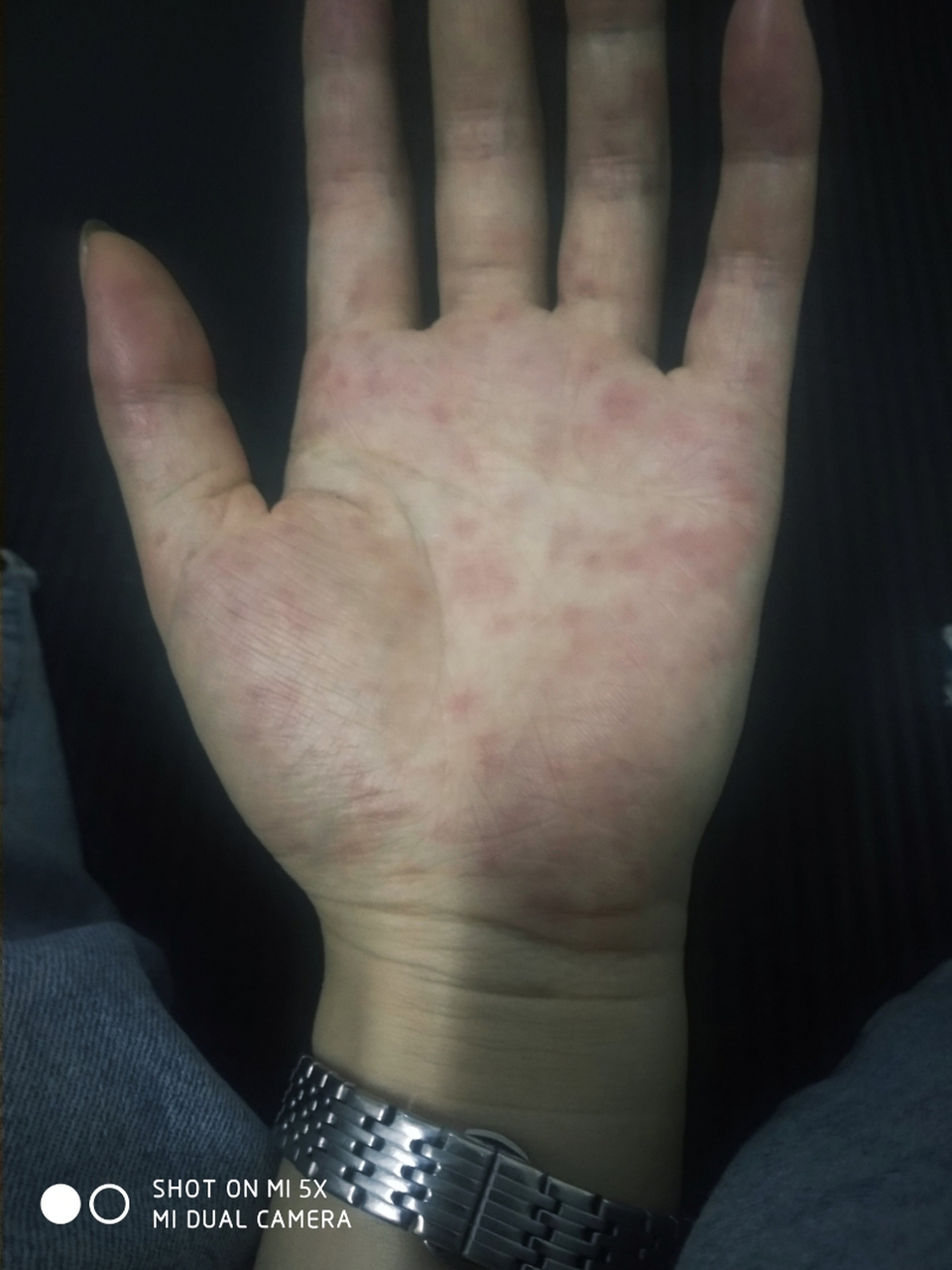 每年总有那么几次手掌心奇痒无比,然后就是这个样子,或者是是小水泡