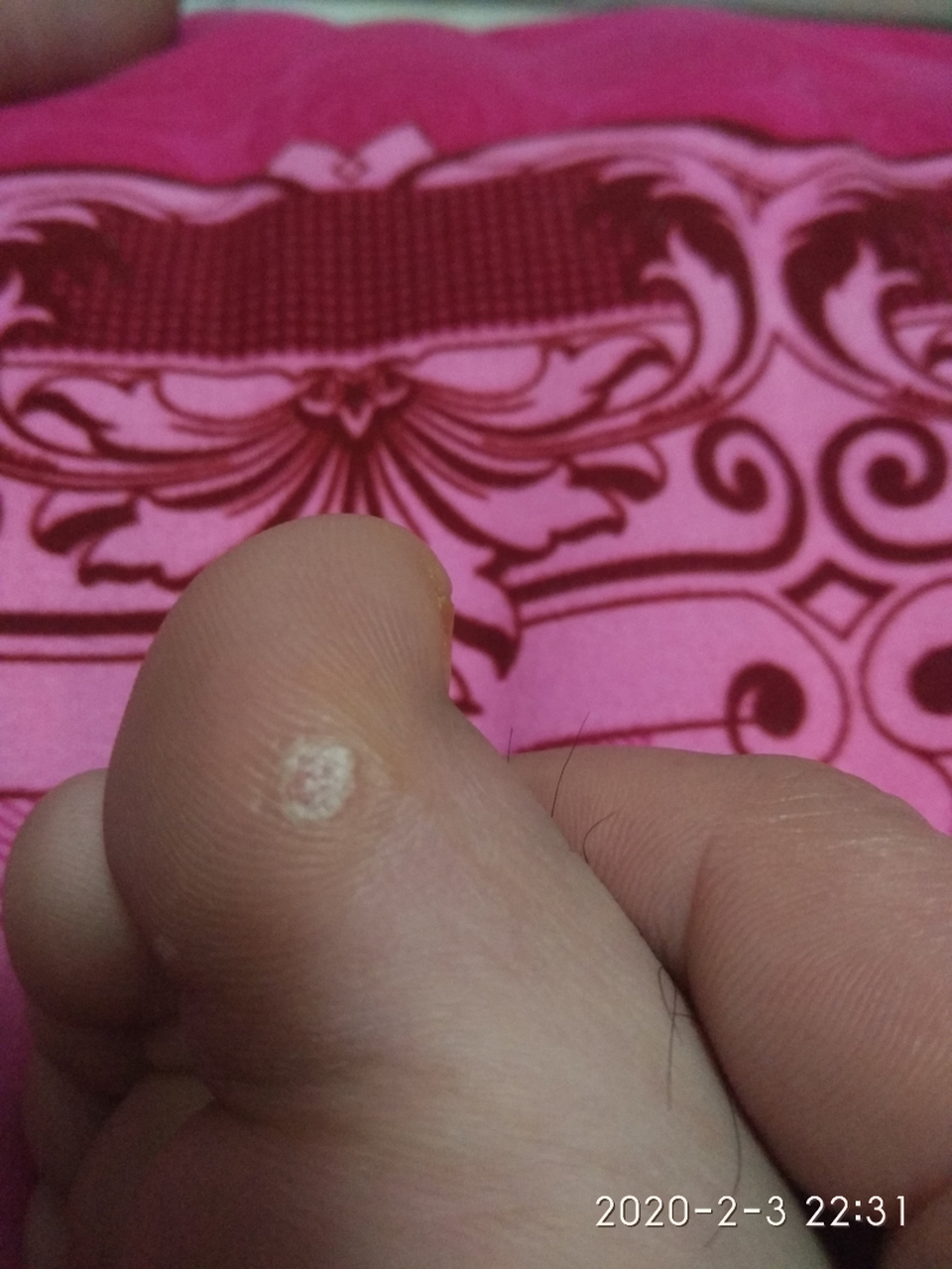 各路大神看看我这个是不是血胞刺啊!修脚店说是血胞刺会传染的!